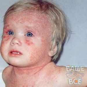 Аллергический кашель у ребенка комаровский