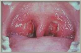 Стрептококковая инфекция горла у детей