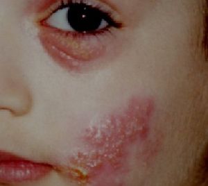 Вирусный кашель у ребенка
