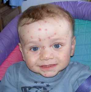 Лечение соплей у детей комаровский